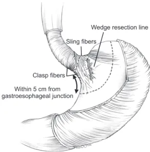 Fig. 1. Illustration for the hypothesis of the development  of gastroesophageal reflux disease after a gastric wedge  resection  for  a  submucosal  tumor  located  close  to  the  gastroesophageal junction