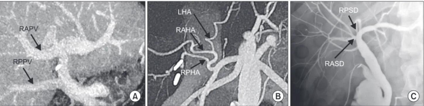 Fig. 2.  Showing vascular and biliary anatomy of the graft. 