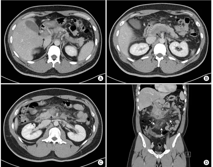 Fig. 3. Initial CT scan showed intraluminal thrombosis in the portal vein (A, arrow), splenic vein (B, arrows), and superior  mesenteric vein (C, arrow)