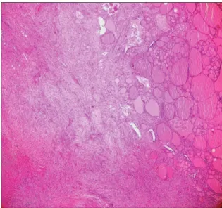 Fig. 1. Ultrasound of neck showed 2.71 cm × 2.59 cm solid nodule arising from  left thyroid lobe.