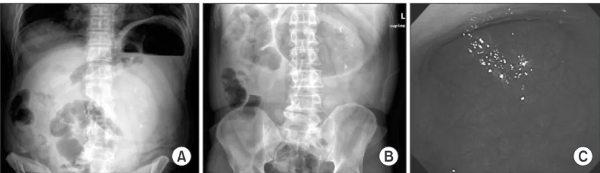 Fig. 1 shows the initial simple abdominal X-ray and the  endoscopic image. Both the abdominal erect and supine  X-ray views reveal the distention and air-fluid levels in  the stomach (Fig