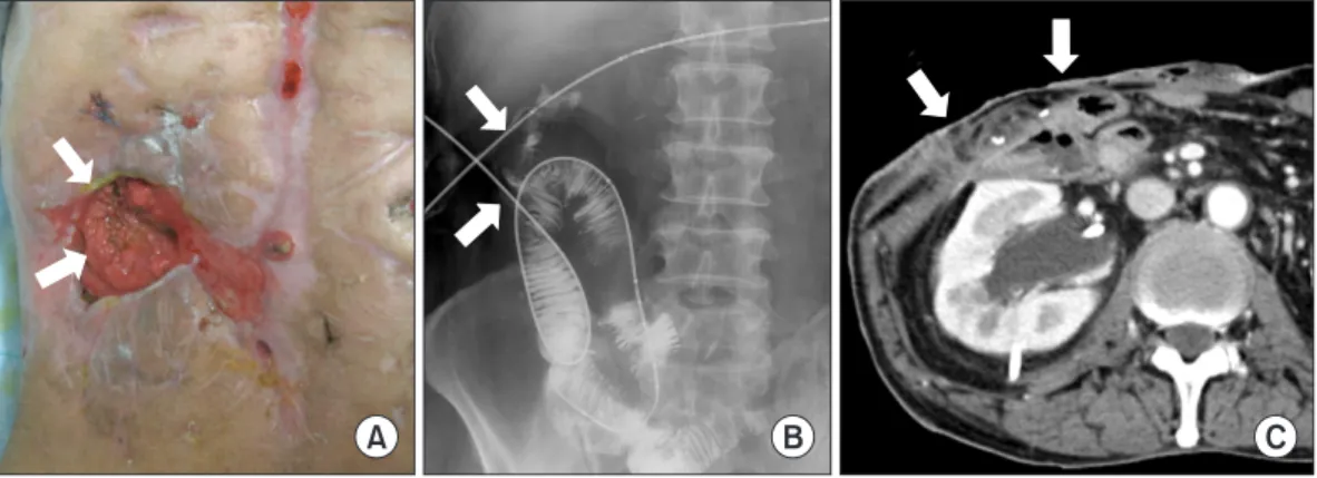 Fig. 2. Photograph of a covered retrievable expandable nitiol stent.