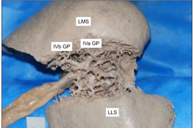 Table 1. Characteristics of traditional GP (II, III, IVa, and IVb) and additional  pedicle