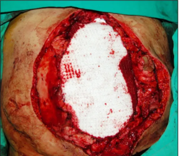 Fig. 2. Appearance after inflation of tissue expanders to total  volume of 2,350 mL each.