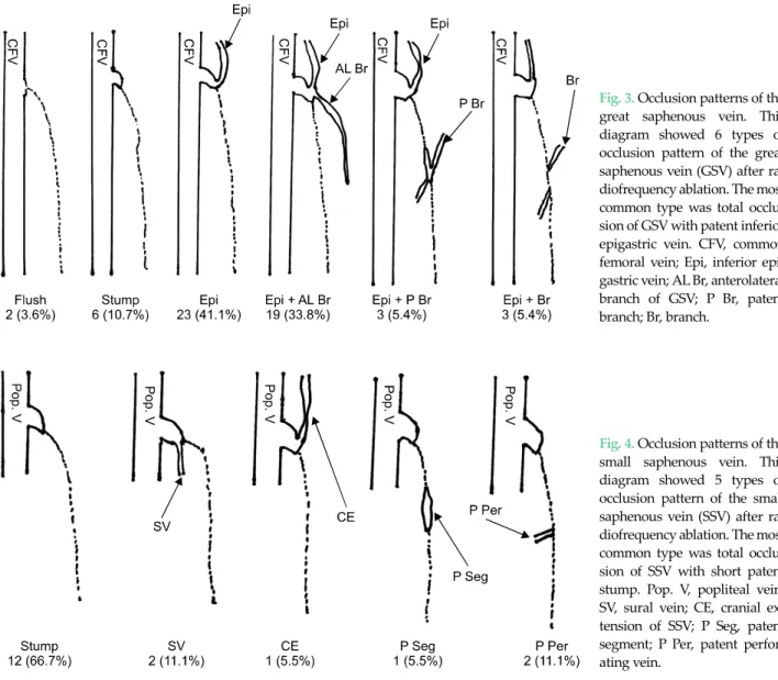Fig. 3. Occlusion patterns of the  great saphenous vein. This  diagram showed 6 types of  occlusion pattern of the great  saphenous vein (GSV) after  ra-diofrequency ablation