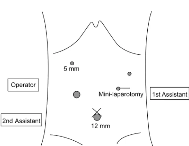 Fig. 1. Ports placement for laparoscopy-assisted total gastrectomy  with para-aortic lymphadenectomy.