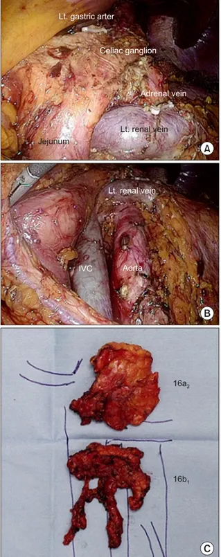 Fig. 2. (A) Completed 16a 2  lymph node dissection. (B) Completed  16b 1  lymph node dissection