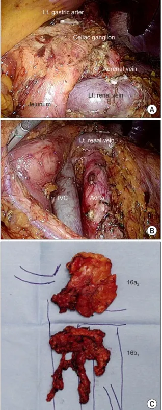 Fig. 2. (A) Completed 16a 2  lymph node dissection. (B) Completed  16b 1  lymph node dissection
