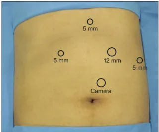 Fig. 1. Trocar placement for laparoscopic fundoplication. Two 12  mm trocars and three 5 mm trocars are shown.