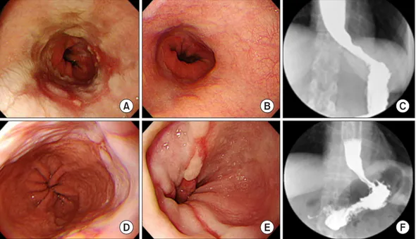 Fig. 2. (A‒C) A 42-year-old female patient was administered 30 mg lansoprazole QD for 17 months, but was hospitalized due to the lack of  improvement in dysphagia
