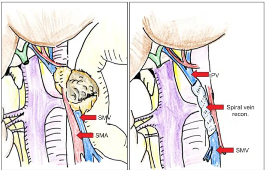 Fig. 3. Schematic illustrations of  superior mesenteric vein (SMV)  reconstruction with a spiral graft  with a great saphenous vein
