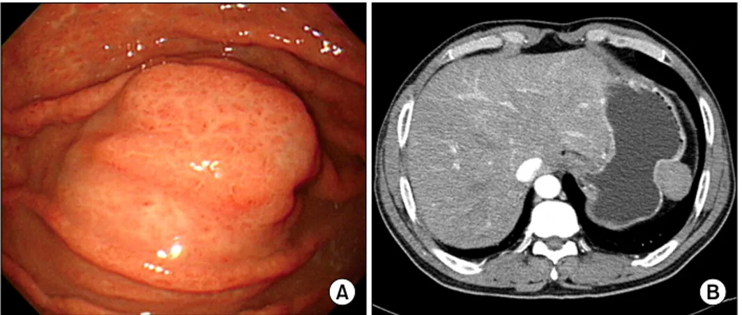 Fig. 1. (A) Endoscopic evaluation  reveals the polypoid submucosal  mass in the greater curvature of the  gastric fundus with mild  erythema-tous mucosa