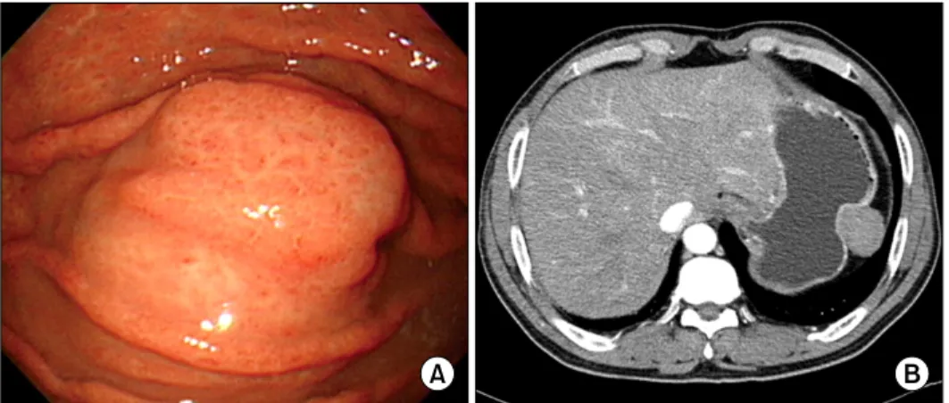 Fig. 1. (A) Endoscopic evaluation  reveals the polypoid submucosal  mass in the greater curvature of the  gastric fundus with mild  erythema-tous mucosa