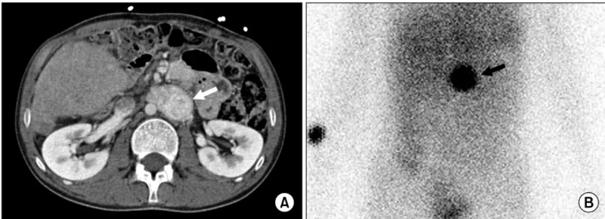 Fig. 1. Para-aortic mass (arrow) is well defined on computed tomography (A) and metaiodobenzylguanidine test (B).