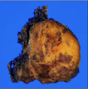 Fig. 2. The permanent pathology reported the tumor as  extra-adrenal pheochromocytoma, with a high risk of malignancy.