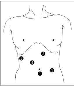 Fig. 1. Position of trocars. The operator used 3rd and 4th trocar on  the right side of the patient and the assistant used 2 trocars on the  left side