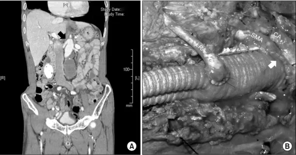 Fig. 1. (A) Computed tomography angiogram of supra-renal abdominal aortic aneurysm (AAA) (black arrow), which involves the origin of  both renal arteries