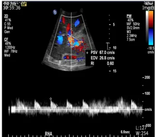 Fig. 1. Postoperative Doppler sonogram demonstrating normal  pulsatile flow of the right hepatic artery with a resistive index of 0.6.