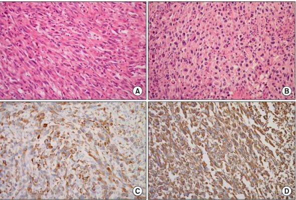 Fig. 2. Microscopically, tumor is composed of atypical spindle (A: H&amp;E, ×200) and discohesive giant polygonal cells (B: H&amp;E, ×200) in  inflammatory background