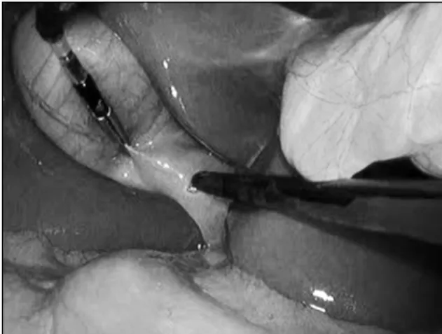 Fig. 1. Articulating grasper is being used at infundibulum, or  Hartmann’s pouch, for lateral dissection without any stay suture  for cephalad retraction of gall bladder body.