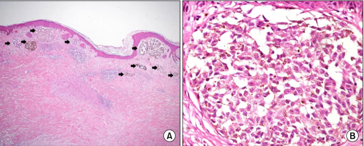 Fig. 1. A 59-year-old woman with a 2.0 × 1.5 cm sized and an  ulcerative pigmented skin lesion in the right breast.