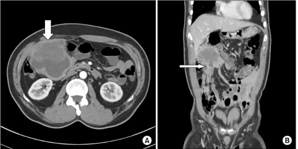 Fig. 1. Endoscopic ultrasound shows 6.7 × 7.1 cm-sized huge mass  on gallbladder body extended to omentum but not invaded into  duodenum.