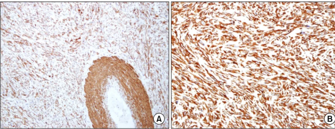 Fig. 5. Higher magnification of spindle cell component displaying  marked nuclear atypia and mitosis (62/10 high-power fields  [HPFs]; H&amp;E, ×400).