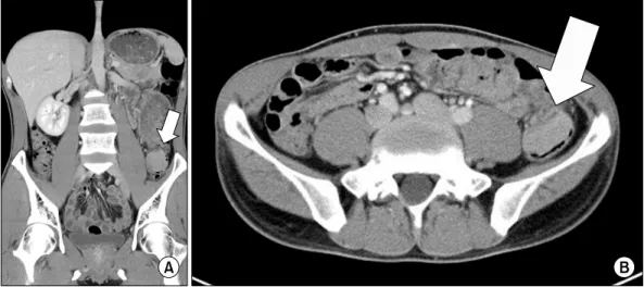 Fig. 1. Endoscopic examination reveals a 4 cm sized irregularly  margined mass with intact mucosa (margin) and shallow ulcer  (central) in descending colon.