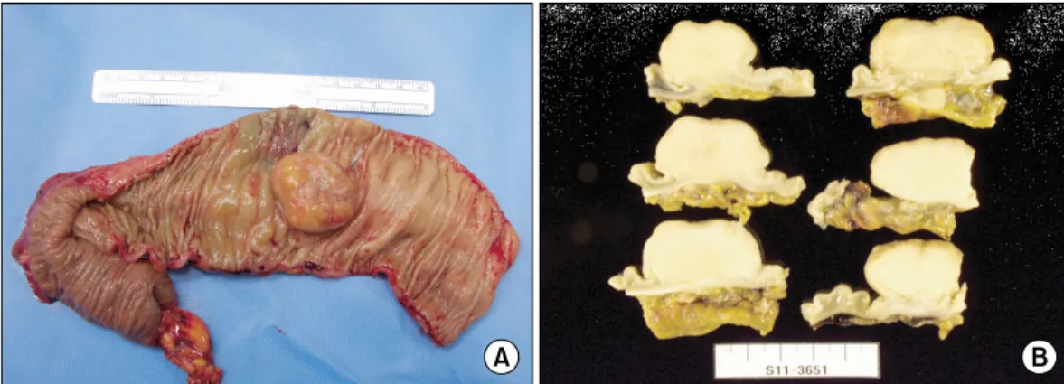 Fig. 3. Gross examination reveals a 3.9 × 3.8 cm sized, fungating, white to yellow colored and hard mass in descending colon
