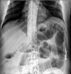 Fig. 1. Simple abdominal X-ray presents multiple dilated small  bowel loops.