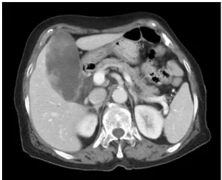 Fig. 1. Abdomen computed tomography showed diffuse distension  of gallbladder (GB) with irregular intraluminal polypoid masses -  possible GB cancer rather than xanthogranulomatous cholecystitis.