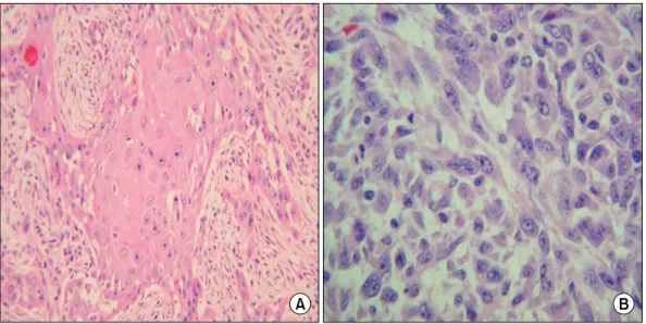 Fig. 2. Microscopic finding. (A) Well differentiated squamous cell carcinoma components (H&amp;E, ×200)