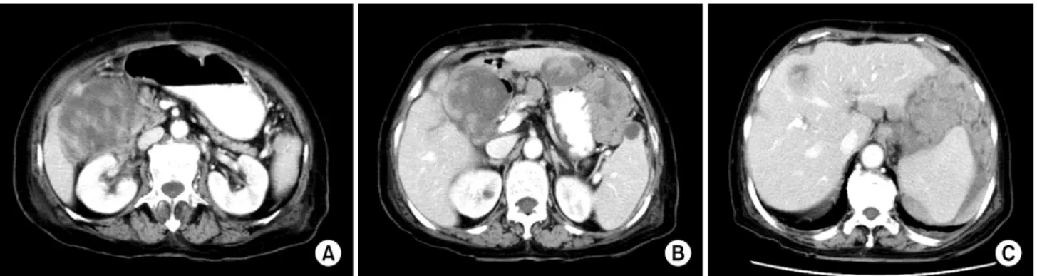 Fig. 4. Abdomen computed tomography showed huge metastatic mass involving liver S4 (A), and duodenum 1st portion (B)