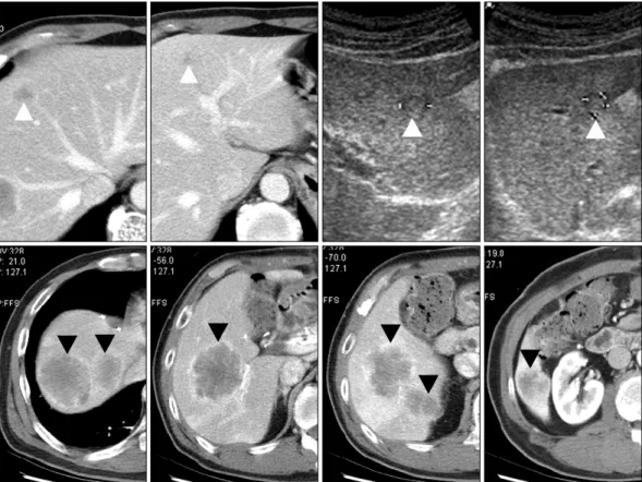 Fig. 1. Initial abdominal ultrasonography and computed tomography. Four lesions in left lobe and 5 lesions in right lobe were found (white  arrow, metastases in left lobe; black arrow, metastases in right lobe).