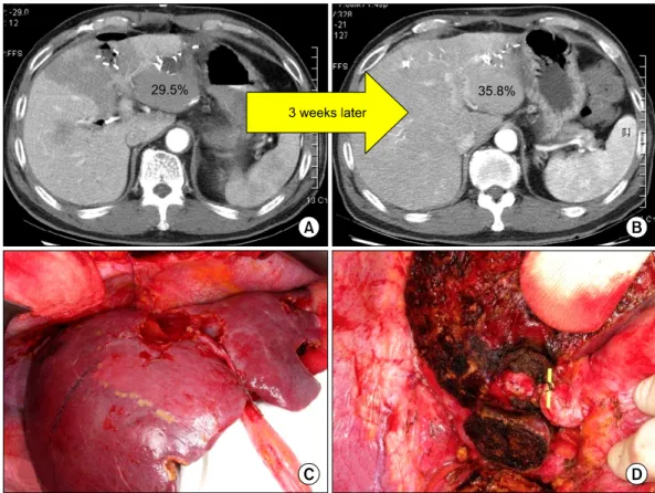 Fig. 2. (A) Abdominal computed tomography (CT) that was checked the day after first hepatectomy