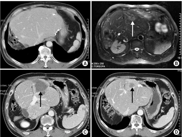 Fig. 3. (A) Abdominal computed tomography (CT) taken at 15 months after second-stage hepatectomy showed no recurrent lesion