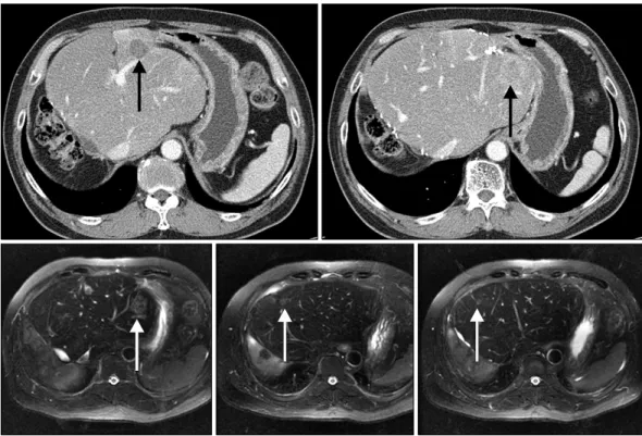 Fig. 4. Abdominal computed tomography and magnetic resonance image taken at 36 months after second-stage hepatectomy (arrows,  multiple recurrent lesions).