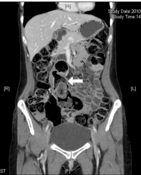 Fig. 1. Axial view abdominal computed tomography scan showing  thickened bowel wall (white arrow) and segmental dilatation with  stasis of intraluminal content.