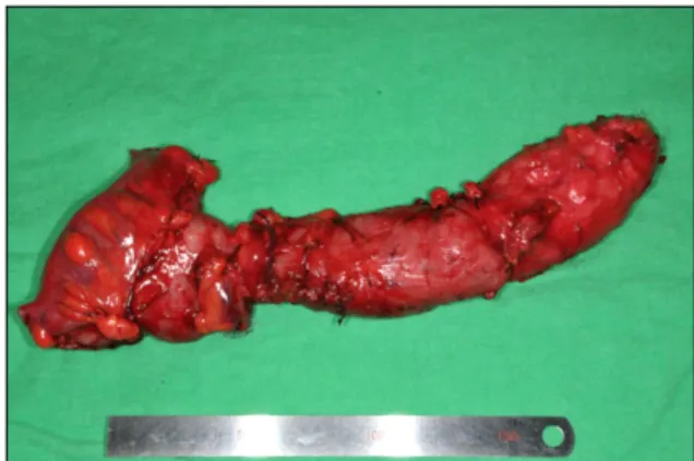 Fig. 5. Final attachment of blind end of colonic duplication to  peritoneum overlying aortic bifurcation.