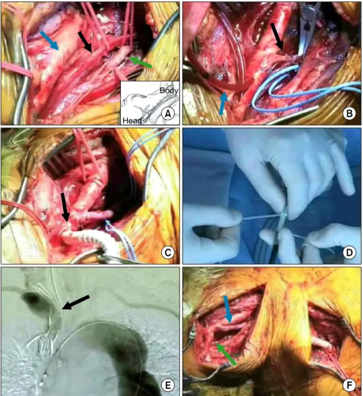 Fig. 3. Intra-operative pictures of  the hybrid surgery. (A) Exposure  of the right common carotid artery  and right vertebral artery (blue  arrow, carotid artery; green arrow,  vertebral artery; black arrow,  va-gus nerve)