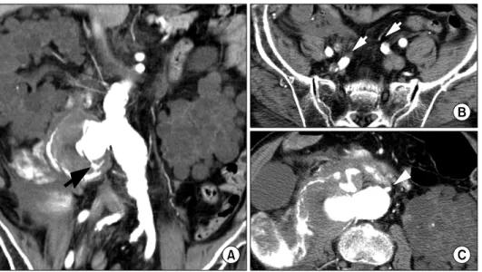 Fig. 1. Preoperative computed  tomography scan. Abdominal  aor-tic aneurysm with contrast leakage  (black arrow) was found (A),  bila-teral internal iliac arteries (white  arrows, B) inferior mesenteric  ar-tery (arrowhead, C) were patent