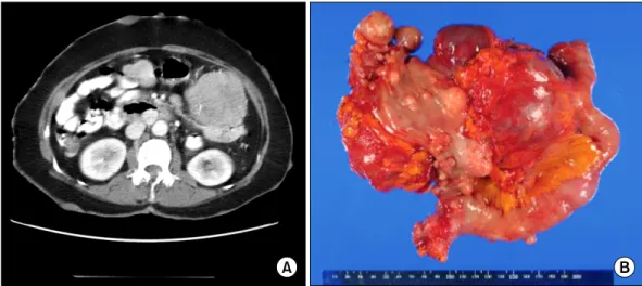 Fig. 2. Radiologic and gross appearance of small bowel gastrointestinal stromal tumor