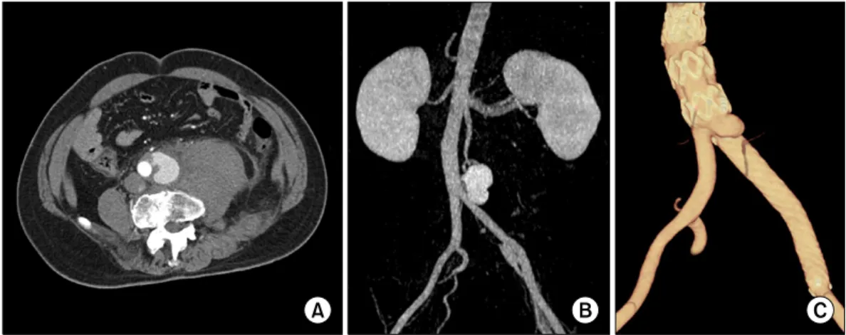 Fig. 1. (A, B) Preoperative computed tomography (CT) scan shows retroperitoneal hematoma and saccular-shaped pseudoaneurysm at left  lateral wall of distal abdominal aorta at 1 cm proximal to aortic bifurcation