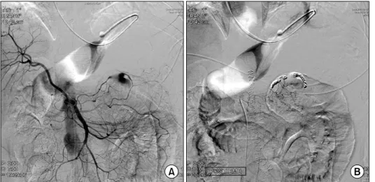 Fig. 3. (A) Mesenteric angiography  on 6th day after open surgical repair  of aortic aneurysm shows  pseudoa-neurysm formation at small branch  of middle colic artery