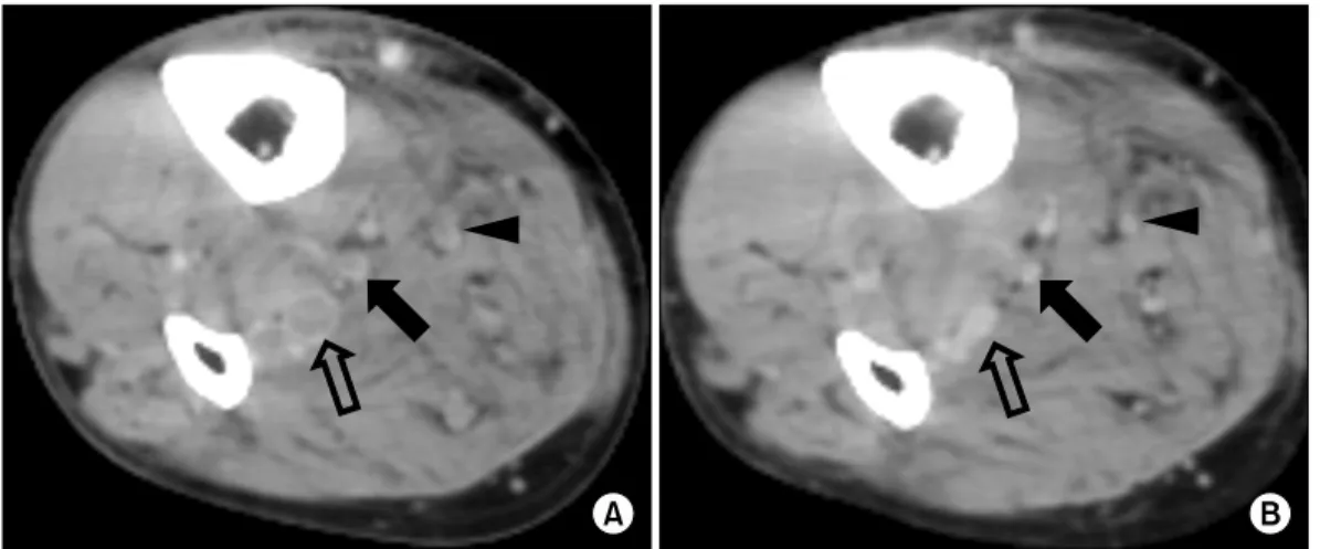 Fig. 2. Computed tomography (CT) of 67-year-old man who underwent right total knee arthroplasty (TKA)