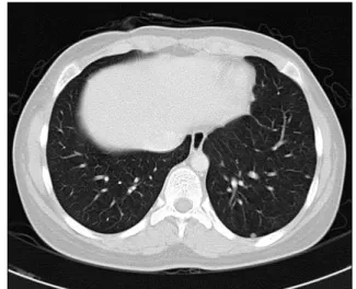 Fig. 1. Well-defined mass (4 cm) with multifocal cystic area in the  right thyroid gland