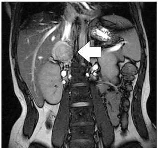 Fig. 1. Computed tomography scan shows hypervascular mass  with dimensions of 4.3 × 3.2 cm on right adrenal gland with early  washout enhancing pattern
