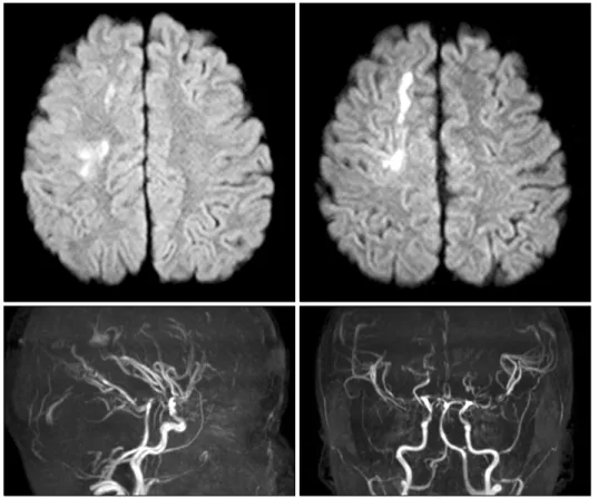 Fig. 1. Brain-magnetic resonance  imaging and magnetic resonance  angiography examination on post-  operative day 12 showed acute  cerebral infarction at subcortical  white matter of right hemisphere  and multiple stenoses of both  anterior cerebral artery