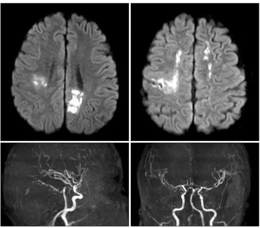 Fig. 2. Brain-magnetic resonance  imaging and magnetic resonance  angiography examination on post-  operative day 19 showed newly  developed acute cerebral infarction  on subcortical white matter of left  hemisphere, cortex of left parietal  lobe and mildl