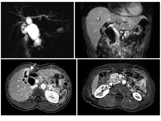 Fig. 1. Magnetic resonance cholan- cholan-giopancreatography (MRCP) image  including vertical and horizontal  sections